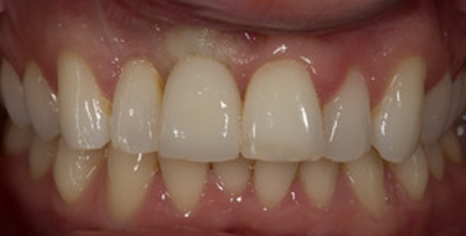 dental implants magherafelt